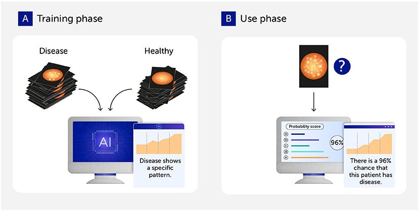 Diagram with two labeled panels. Panel A, titled "Training phase," shows stacks of disease and healthy images input into an AI system to identify disease patterns. Panel B, titled "Use phase," depicts a single medical image analyzed by AI, displaying a 96 percent probability score indicating disease presence.
