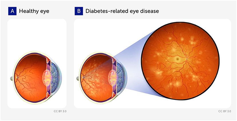 Diagram comparing a healthy eye, labeled A, with smooth retina and clear structure, to an eye with diabetes-related eye disease, labeled B, showing yellowish spots that indicate damage.